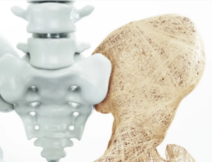 Osteoporose og fysioterapi
